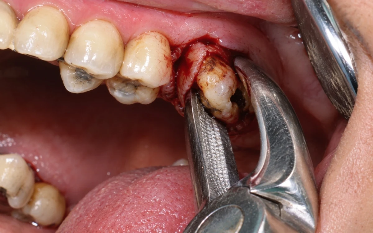Gentle and painless surgical extraction for impacted teeth and deep roots