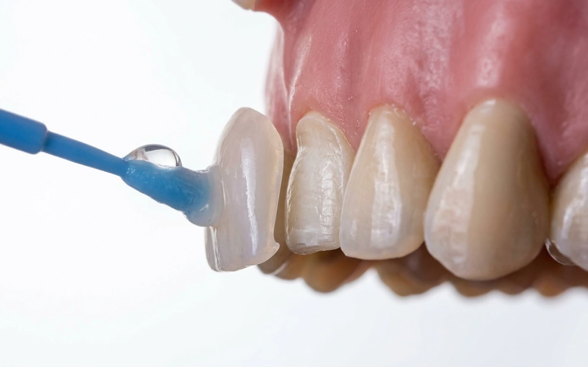 Porcelain Veneers